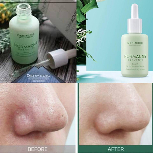 hiệu quả sau khi sử dụng dưỡng da dermedic normacne widened pores serum 