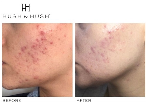 hush & hush skincapsule clear+
