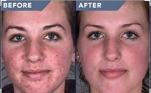 trước và sau khi sử dụng clear cell medicated acne facial scrub