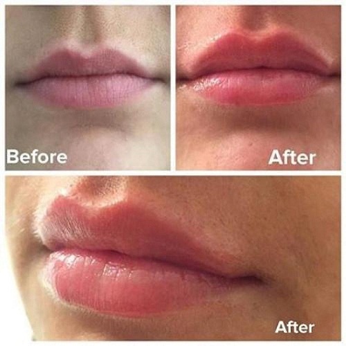 hiệu quả sau khi sử dụng ormedic balancing lip enhancement complex