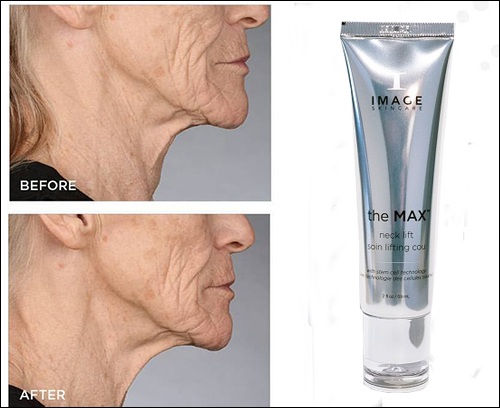 kết quả sau một thời gian sử dụng image the max stem cell neck lift
