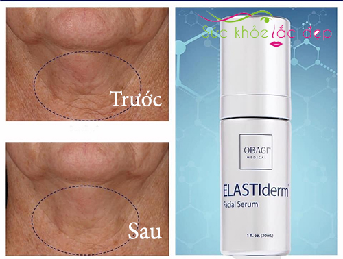 trước và sau khi sử dụng obagi elastiderm facial serum