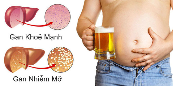 Sử dụng hep forte ngăn ngừa gan nhiễm mỡ dùng nhiều bia